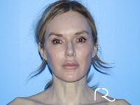 Fractional CO2 Laser Resurfacing Before & After Gallery - Patient 168494172 - Image 1