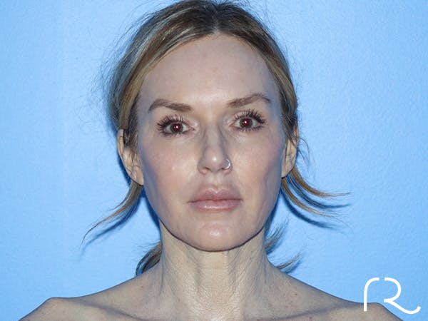 Fractional CO2 Laser Resurfacing Before & After Gallery - Patient 168494172 - Image 1