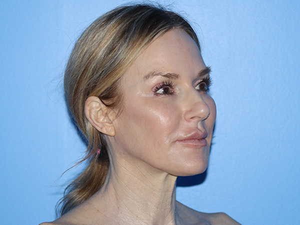 Neck Lift Before & After Gallery - Patient 168494168 - Image 5