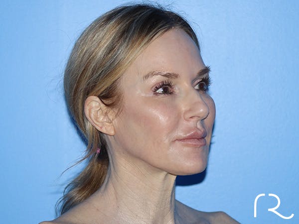 Neck Lift Before & After Gallery - Patient 168494168 - Image 5