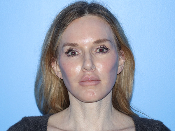 Neck Lift Before & After Gallery - Patient 168494168 - Image 4