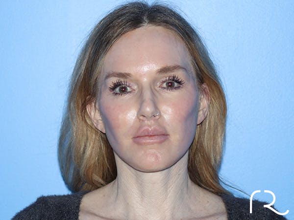 Fractional CO2 Laser Resurfacing Before & After Gallery - Patient 168494172 - Image 2