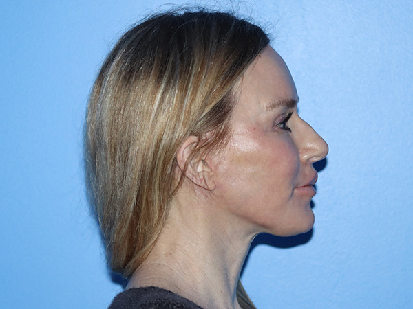 Neck Lift Before & After Gallery - Patient 168494168 - Image 8