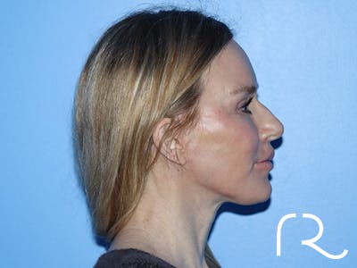 Facelift Before & After Gallery - Patient 168494167 - Image 8