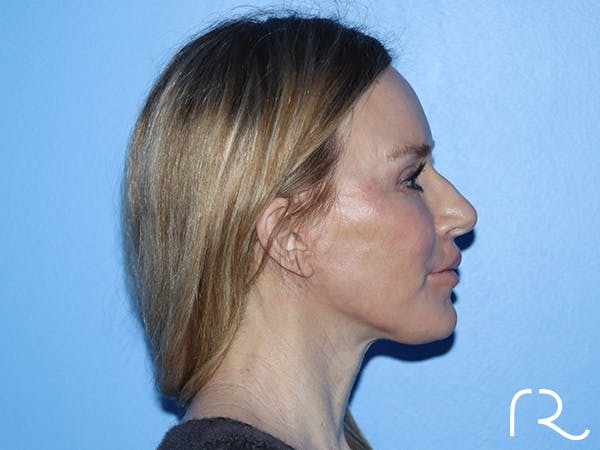 Neck Lift Before & After Gallery - Patient 168494168 - Image 8