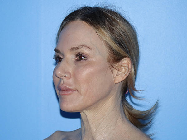 Neck Lift Before & After Gallery - Patient 168494168 - Image 1