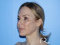 Neck Lift Before & After Gallery - Patient 168494168 - Image 1
