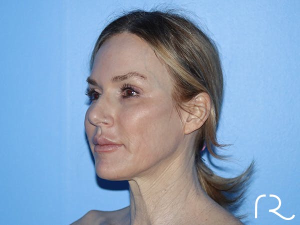 Neck Lift Before & After Gallery - Patient 168494168 - Image 1