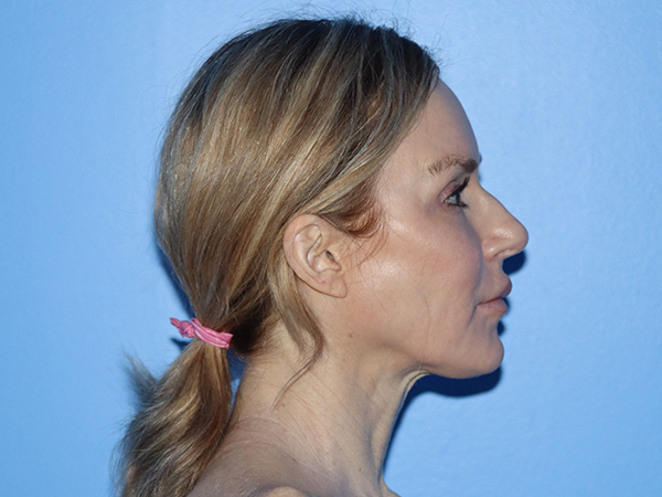Neck Lift Before & After Gallery - Patient 168494168 - Image 7