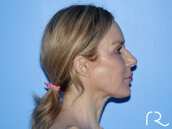 Neck Lift Before & After Gallery - Patient 168494168 - Image 7