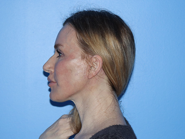 Neck Lift Before & After Gallery - Patient 168494168 - Image 10