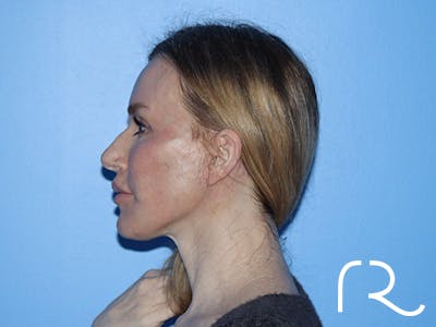 Neck Lift Before & After Gallery - Patient 168494168 - Image 10