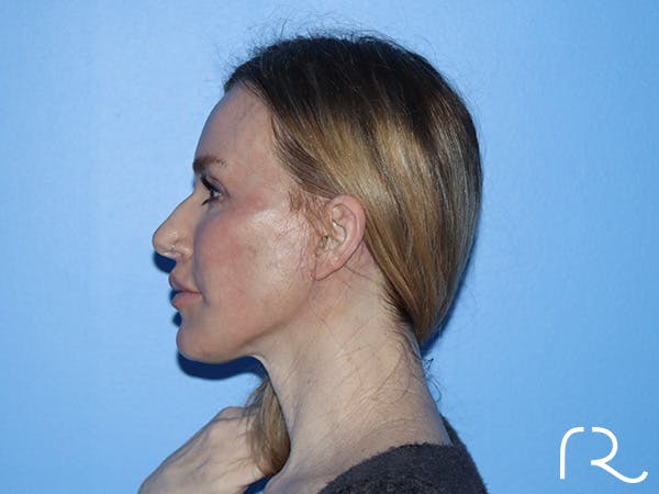 Neck Lift Before & After Gallery - Patient 168494168 - Image 10