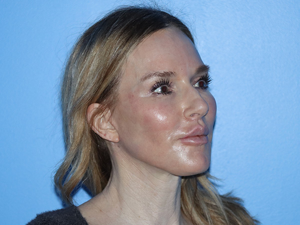 Neck Lift Before & After Gallery - Patient 168494168 - Image 6