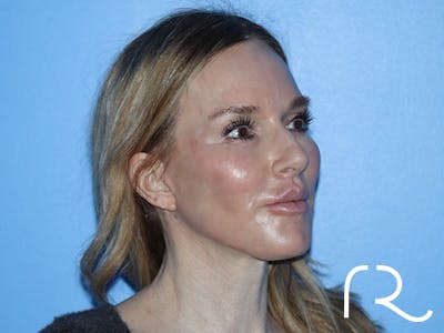 Neck Lift Before & After Gallery - Patient 168494168 - Image 6