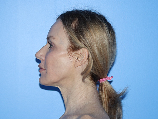 Neck Lift Before & After Gallery - Patient 168494168 - Image 9