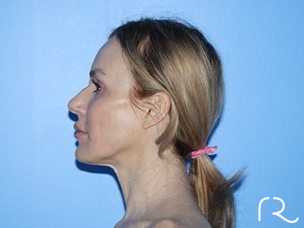 Neck Lift Before & After Gallery - Patient 168494168 - Image 9