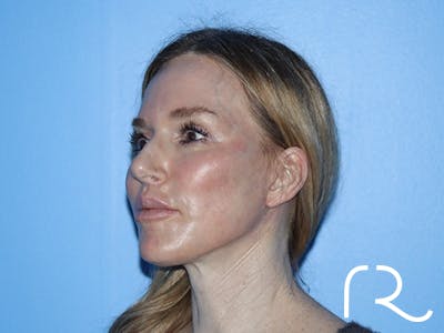 Facelift Before & After Gallery - Patient 168494167 - Image 2
