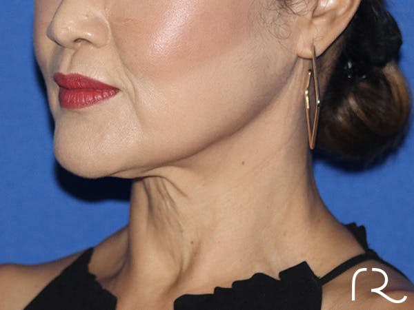 Facelift Before & After Gallery - Patient 168494180 - Image 1