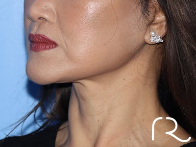 Neck Lift Before & After Gallery - Patient 168494181 - Image 2