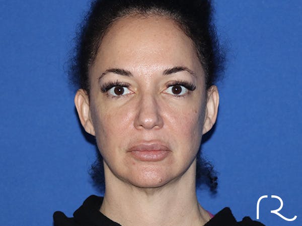 Neck Lift Before & After Gallery - Patient 168494184 - Image 3