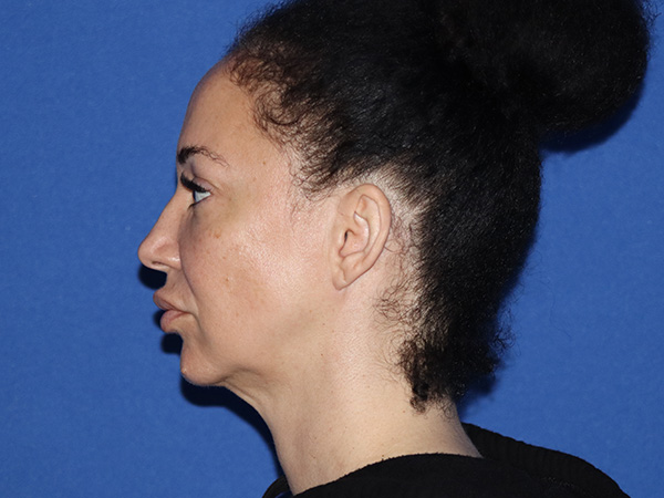 Neck Lift Before & After Gallery - Patient 168494184 - Image 1