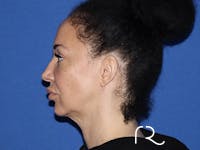 Facelift Before & After Gallery - Patient 168494183 - Image 1
