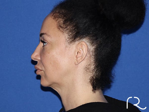 Neck Lift Before & After Gallery - Patient 168494184 - Image 1