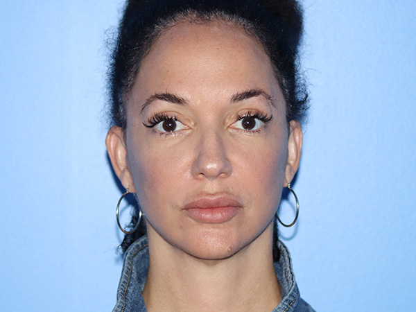 Neck Lift Before & After Gallery - Patient 168494184 - Image 4