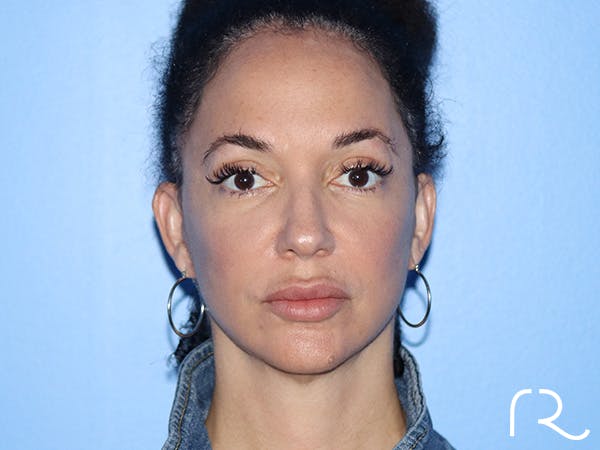 Facelift Before & After Gallery - Patient 168494183 - Image 4