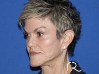 Facelift Before & After Gallery - Patient 168494197 - Image 1
