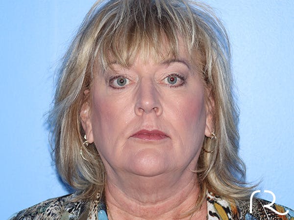 Fractional CO2 Laser Resurfacing Before & After Gallery - Patient 168494432 - Image 1