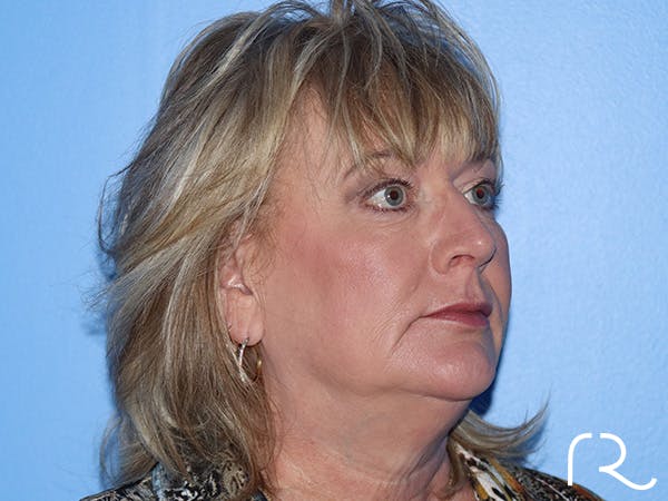 Fractional CO2 Laser Resurfacing Before & After Gallery - Patient 168494432 - Image 3