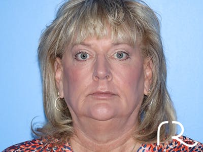 Fractional CO2 Laser Resurfacing Before & After Gallery - Patient 168494432 - Image 2