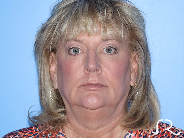 Fractional CO2 Laser Resurfacing Before & After Gallery - Patient 168494432 - Image 2