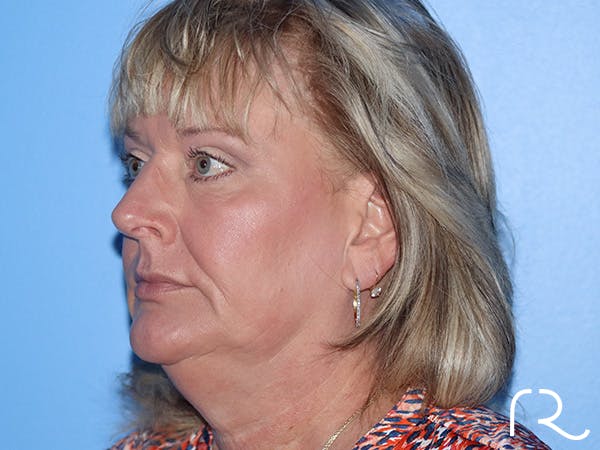 Fractional CO2 Laser Resurfacing Before & After Gallery - Patient 168494432 - Image 6