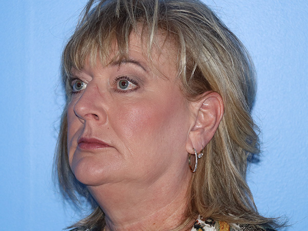 Fractional CO2 Laser Resurfacing Before & After Gallery - Patient 168494432 - Image 5