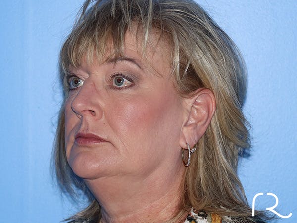 Fractional CO2 Laser Resurfacing Before & After Gallery - Patient 168494432 - Image 5