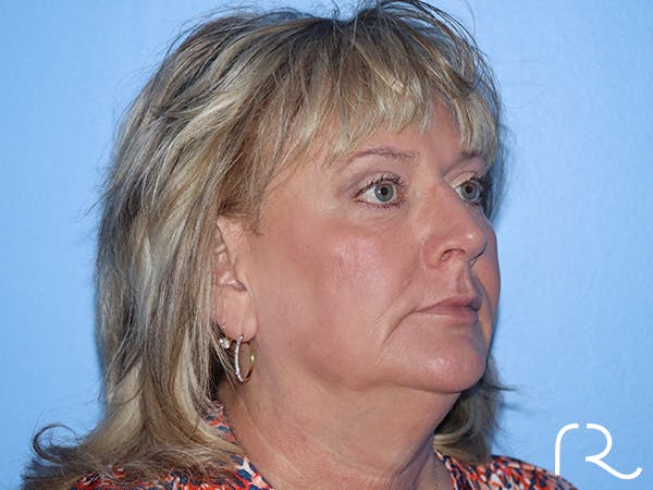 Fractional CO2 Laser Resurfacing Before & After Gallery - Patient 168494432 - Image 4