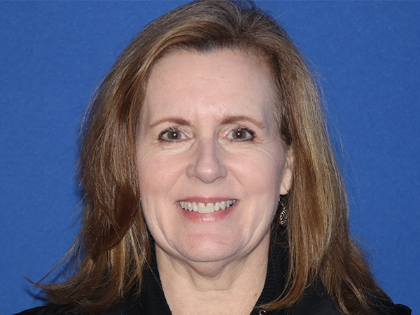 Facelift Before & After Gallery - Patient 168658873 - Image 3