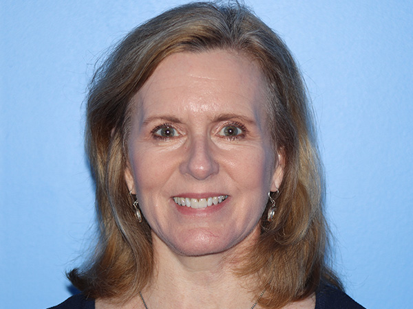 Facelift Before & After Gallery - Patient 168658873 - Image 4