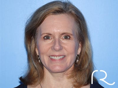 Facelift Before & After Gallery - Patient 168658873 - Image 4