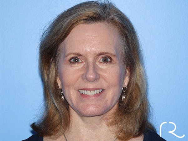 Facelift Before & After Gallery - Patient 168658873 - Image 4