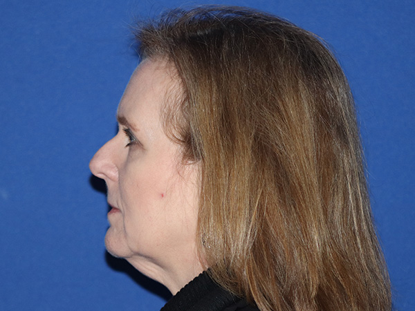 R2 Extended Deep Neck Lift Before & After Gallery - Patient 168658879 - Image 1