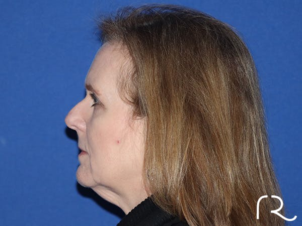 Extended Deep Neck Lift Before & After Gallery - Patient 168658879 - Image 1
