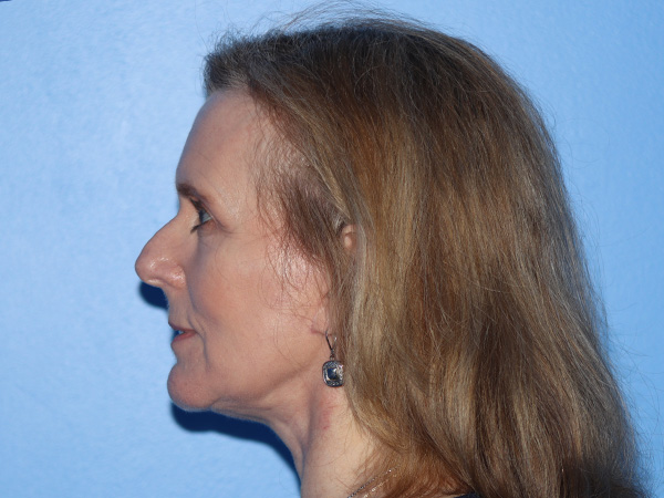 Facelift Before & After Gallery - Patient 168658873 - Image 2