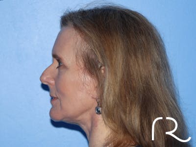 Extended Deep Neck Lift Before & After Gallery - Patient 168658879 - Image 2