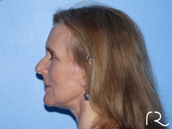 Facelift Before & After Gallery - Patient 168658873 - Image 2