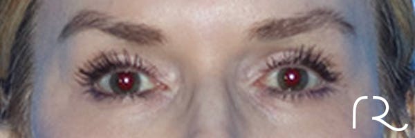 Eyelid Surgery Before & After Gallery - Patient 168494171 - Image 1