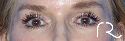 Eyelid Surgery Before & After Gallery - Patient 168494171 - Image 2